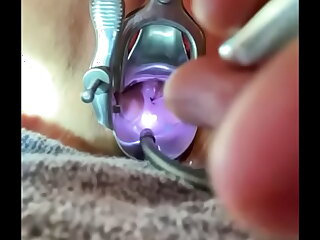 Bakes prolapse suddenly penetrates internal os badly after gentle stable pressure